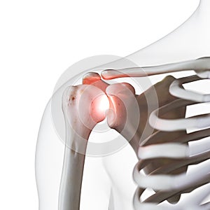 A painful shoulder joint