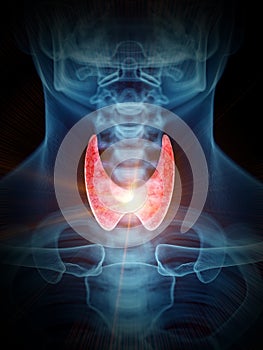 A painful thyroid gland