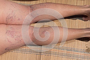 Painful varicose and spider veins