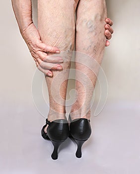 Painful varicose and spider veins on female legs.Woman in heels massaging tired legs