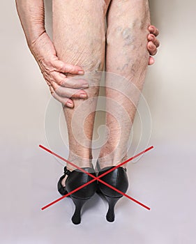Painful varicose and spider veins on female legs.Woman in heels massaging tired legs