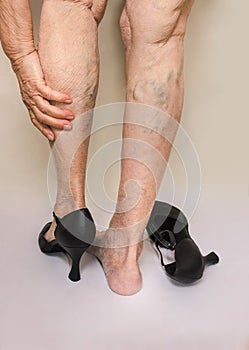 Painful varicose and spider veins on female legs.Woman in heels massaging tired legs