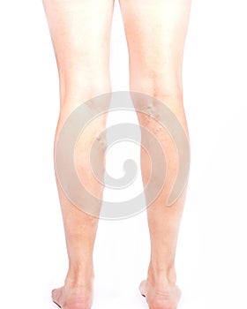 Painful varicose spider veins and on a woman legs, Vascular diseases, Phlebeurysm problems with swollen veins