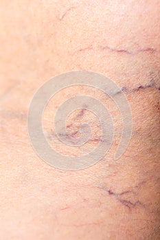 Painful varicose and spider veins on womans legs
