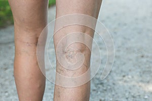 Painful varicose and spider veins on womans legs