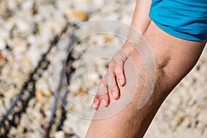 Painful varicose veins