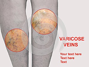 Painful varicose veins,,spider veins, varices on a severely affected leg. Ageing, old age disease, aesthetic problem photo