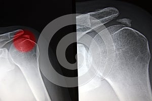 Painfull shoulder, calcific tendonitis, tendinitis