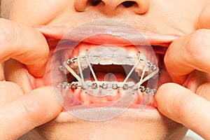 Painfully wearing orthodontic braces and rings
