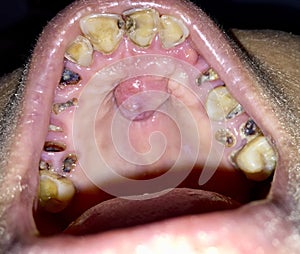 A painless benign growth called palatal torus in the midline of hard palate and broken and stained teeth with caries in mouth.