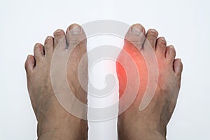 Pair of feet with deformed right toe due to painful gout inflammation