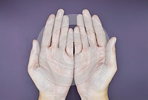 Pale palmar surface of both hands. Anaemic hands of Asian, Chinese man