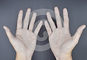 Pale palmar surface of both hands. Anaemic hands of Asian, Chinese man