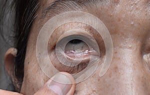 Pale skin of Asian woman. Sign of anemia. Pallor at eyelid photo