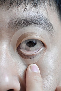 Pale skin of Asian man. Sign of anemia. Pallor at eyelid