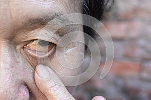 Pale skin of Asian man. Sign of anemia. Pallor at eyelid photo