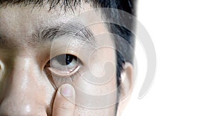 Pale skin of Asian man. Sign of anemia. Pallor at eyelid photo