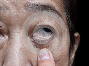 Pale skin of Asian woman. Sign of anemia. Pallor at eyelid