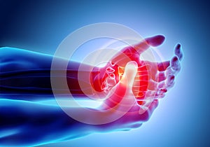 Palm painful - skeleton x-ray, Medical concept.