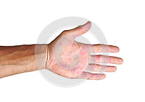 Palm patient erythema in red spots from inflammation isolated photo