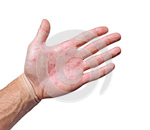 Palm patient erythema in red spots from inflammation photo