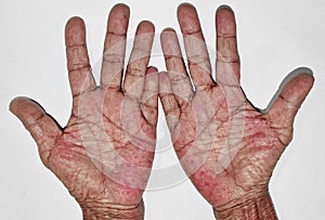 Palmar erythema often called liver palm in Southeast Asian, Myanmar woman.