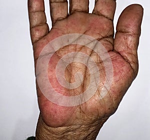 Palmar erythema often called liver palm in Southeast Asian, Myanmar woman. photo