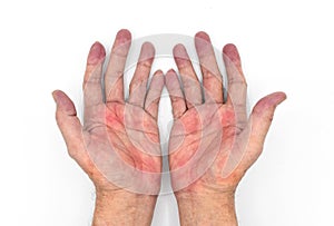 Palmar erythema often called liver palms in both hands of Southeast Asian, Myanmar man