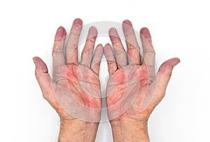 Palmar erythema often called liver palms in both hands of Southeast Asian, Myanmar man photo
