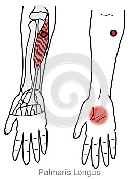 Palmaris longus myofascial trigger points and hand palm pain photo