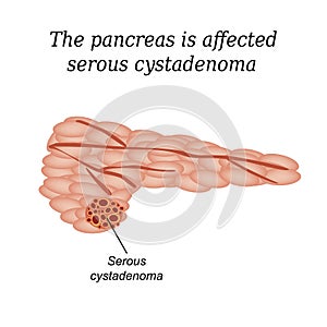 The pancreas is affected serous cystadenoma