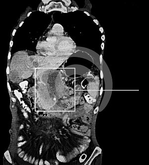 Pancreas cancer. Computed tomography reconstruction.