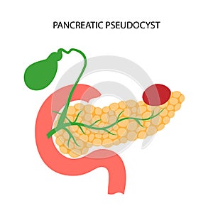 Pancreas disease and cancer