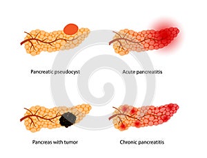 Pancreas disease and cancer