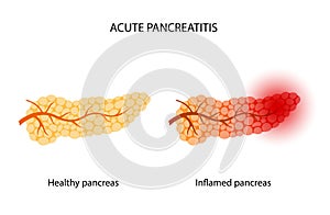 Pancreas disease and cancer