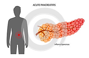 Pancreas disease and cancer