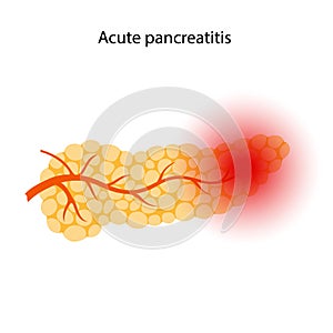 Pancreas disease and cancer