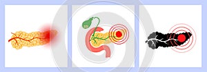 Pancreas disease and cancer