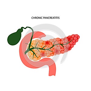 Pancreas disease concept