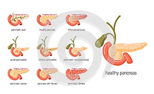 Pancreas diseases concept in flat style, vector