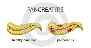 Pancreas healthy and pancreatitis