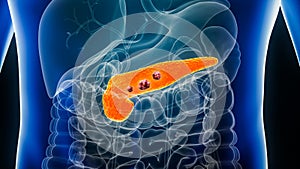 Pancreas or pancreatic cancer with organs and tumors or cancerous cells 3D rendering illustration with male body. Anatomy,