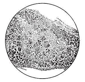 Pancreas showing increase of fibrous tissue, vintage engraving