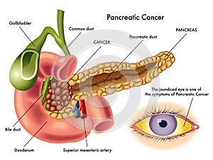 Pancreatic cancer