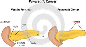 Páncreas cáncer 