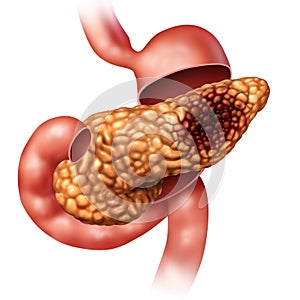 Pancreatic Cancer Concept