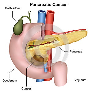 Pancreatic cancer medical  illustration