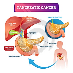 Pancreatic cancer vector illustration. Labeled ill stomach oncology disease