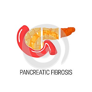 Pancreatic fibrosis concept. Vector illustration