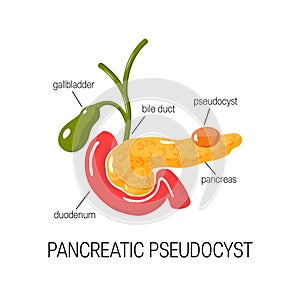 Pancreatic pseudocyst concept. Vector illustration